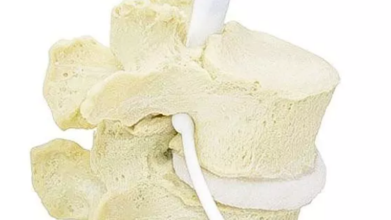 Lumbar Spinal Stenosis — A Clinical Update and Approach to Patient Care