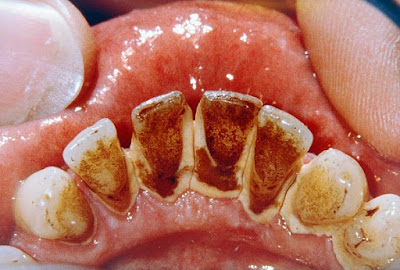 Quy trình cạo vôi răng tại nha khoa