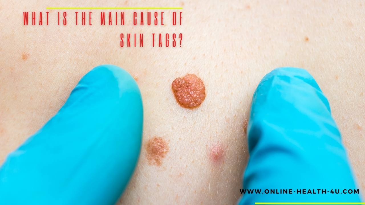 Skin-Tags-causes-symptoms-on-neck-treatment-2021