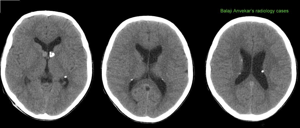 Dr Balaji Anvekar S Neuroradiology Cases Tuberous Sclerosis