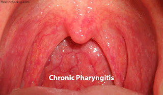 Infective Pharyngitis Symptoms and Causes