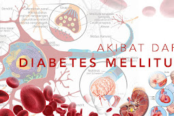 Jual Obat Herbal Diabetes Ampuh Di Langkat | WA : 0822-3442-9202