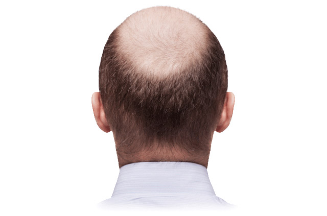 Does hair lose? try these remedies for the health of your hair. Does hair lose? try these remedies for the health of your hair.