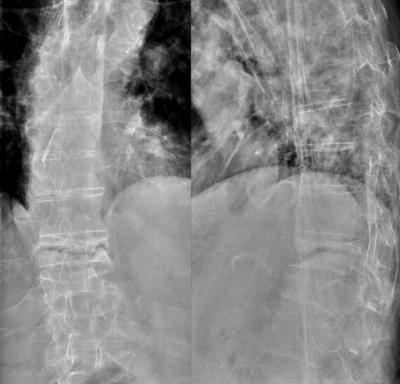 Complicated chronic vertebral compression fracture