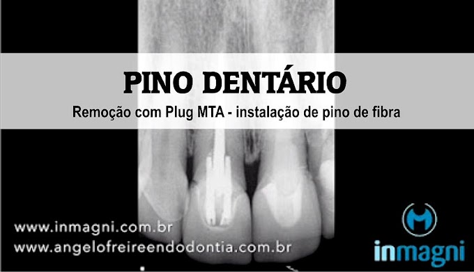 PINO DENTÁRIO: Remoção com Plug MTA - instalação de pino de fibra - Núcleo