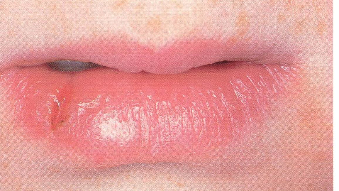 Lip lesions | Nuffield health