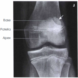 PA Patella