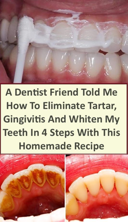 A Dentist Friend Told Me How To Eliminate Tartar, Gingivitis and Whiten