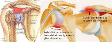Douleur epaule droite signification