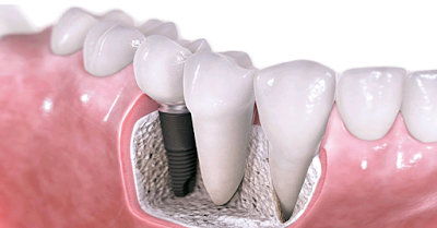 tooth implant cost in Sydney