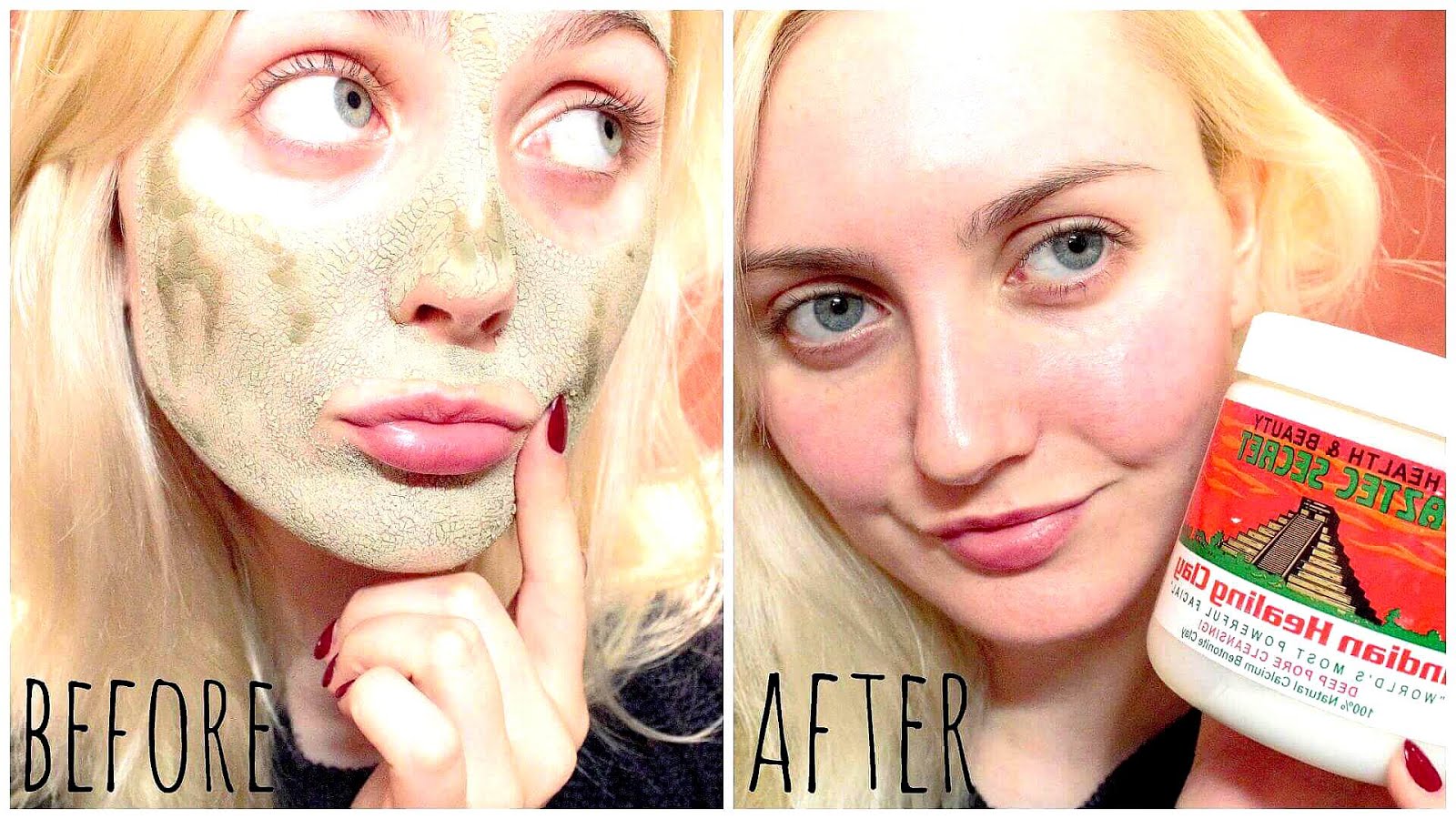 Tea Tree Oil For Acne Results Tree Choices