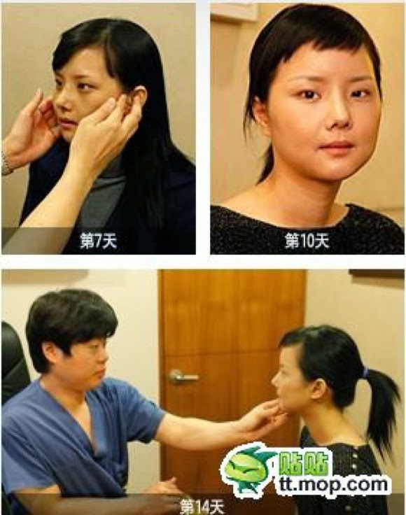 Foto: Wanita Korea Sesudah Dan Sebelum Operasi Plastik Yang Jarang Dan Langka Foto: Wanita Korea Sesudah Dan Sebelum Operasi Plastik Yang Jarang Dan Langka