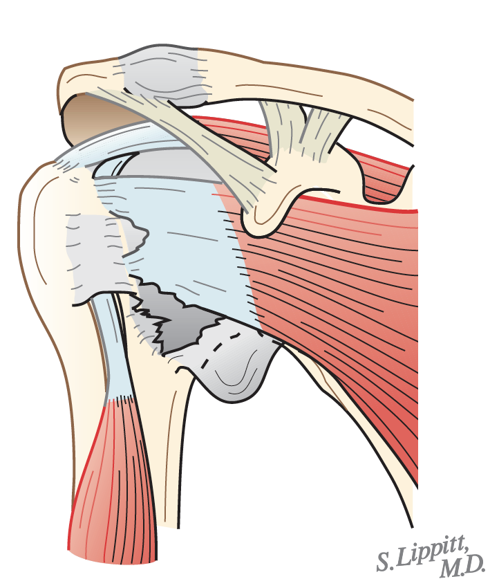 UW Shoulder and Elbow Academy Subscapularis failure after shoulder