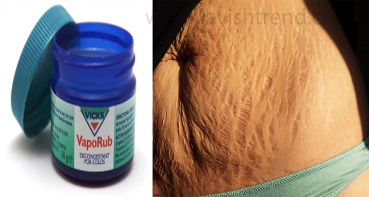How To Use Vicks Vaporub To Get Rid Of Stretch Marks!