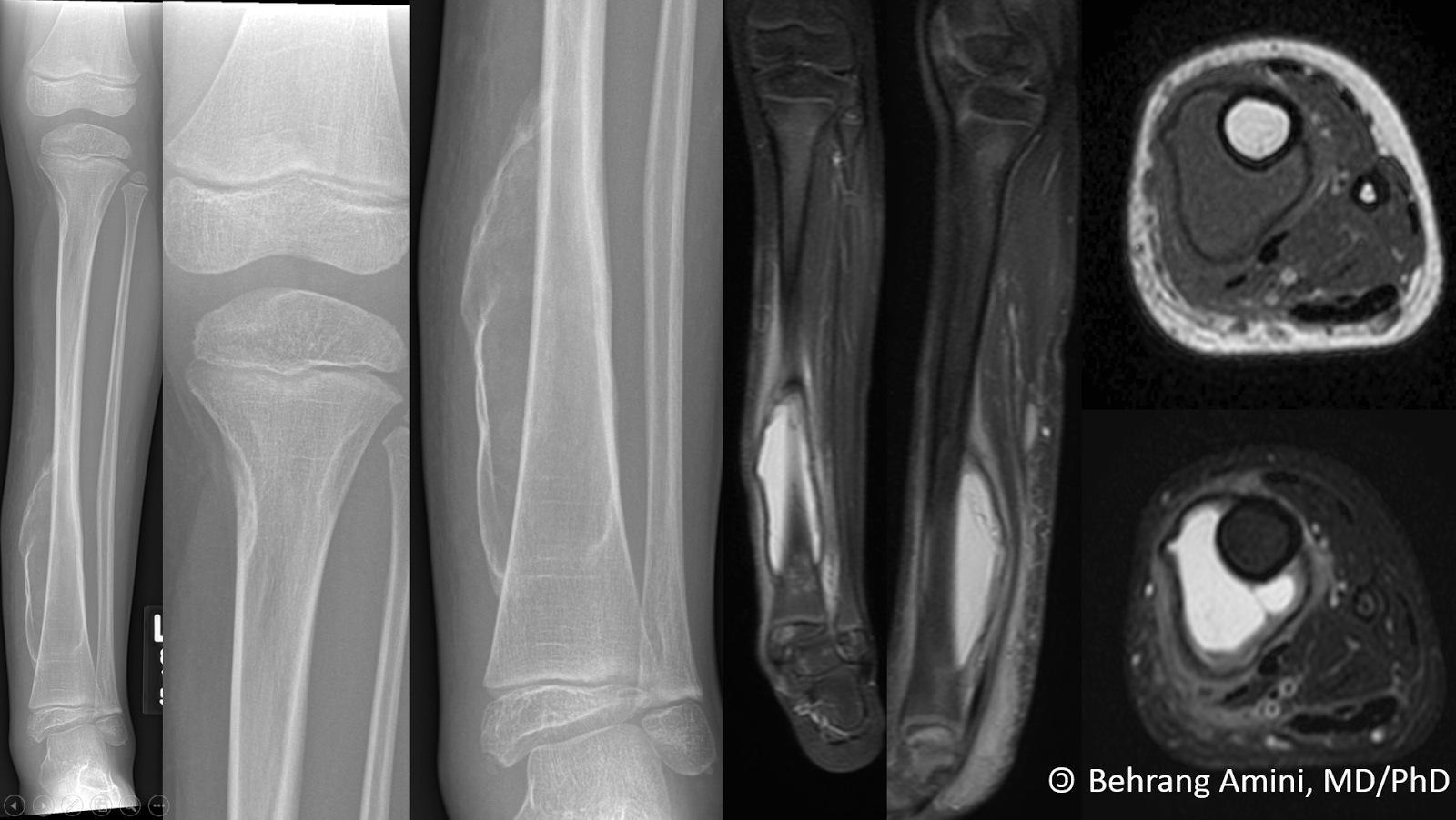 Roentgen Ray Reader Subperiosteal hemorrhage in neurofibromatosis type 1