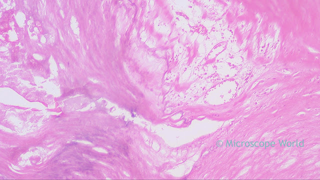 Coronary Atherosclerosis under the microscope at 100x.