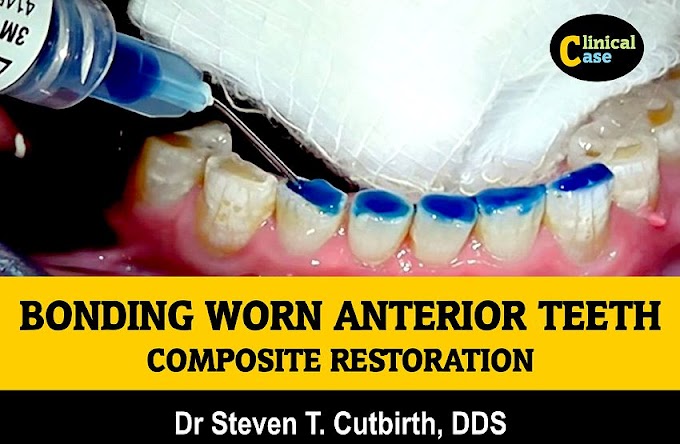 COMPOSITE RESTORATION: Bonding Worn Anterior Teeth - Dr Steven T. Cutbirth, DDS