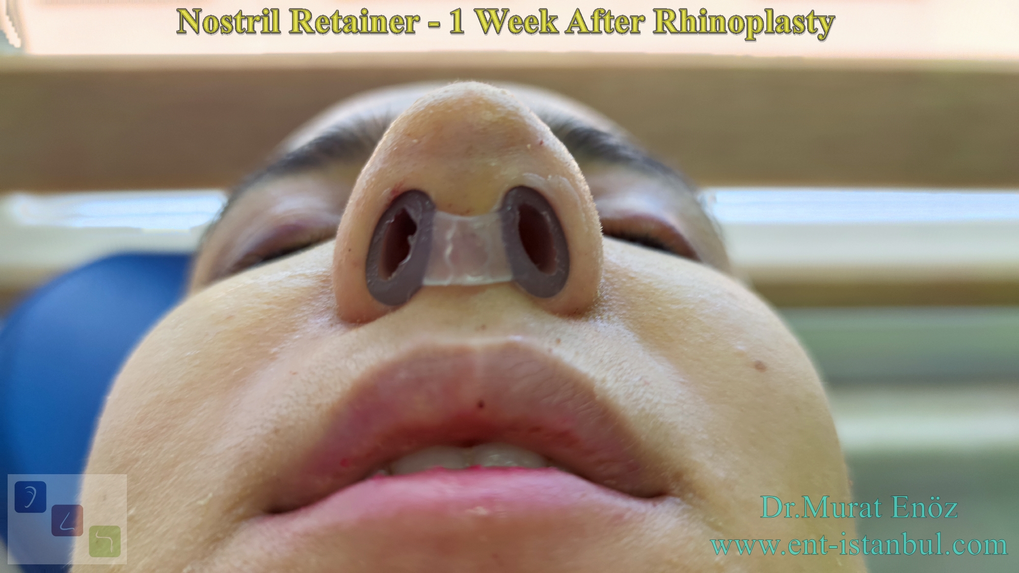 About The Nostril Retainer