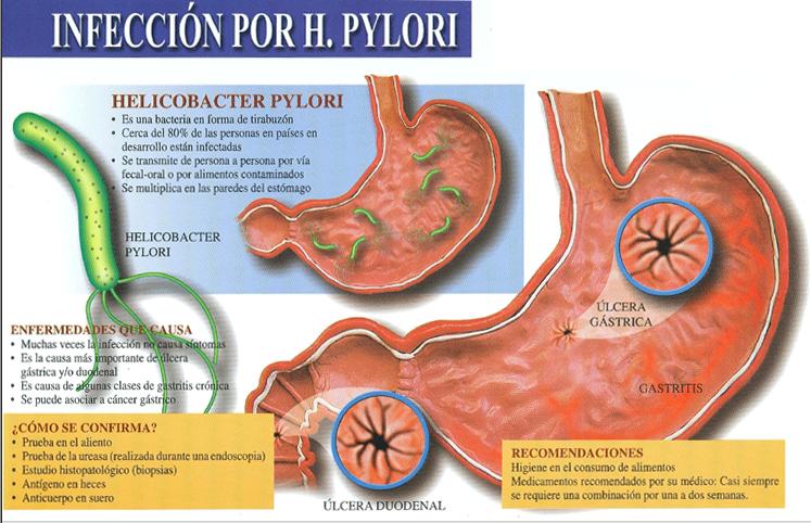 Bacteria del estomago helicobacter pylori tratamiento