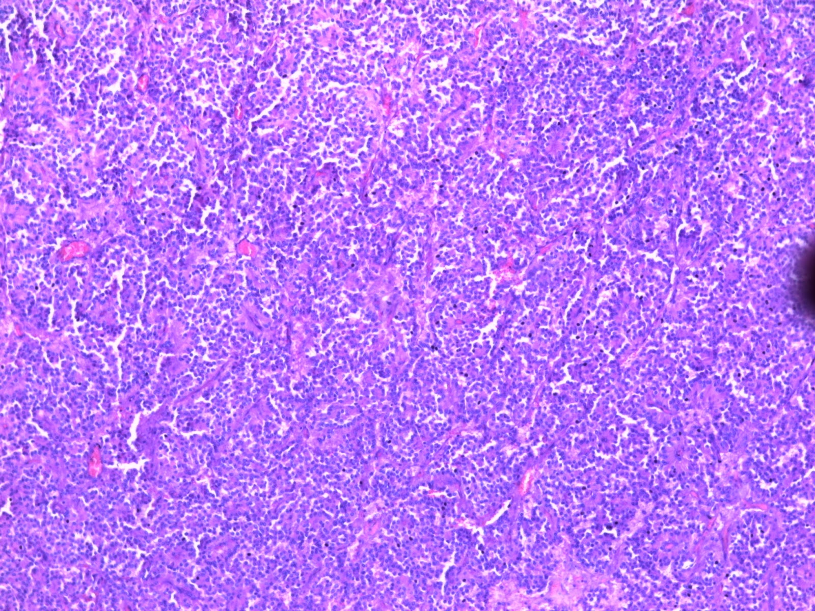 VOLUMEN DE TUMOR METABOLICO