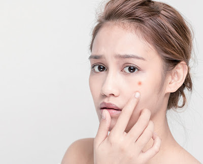 5 Acne Treatment Tips You Can Use Today