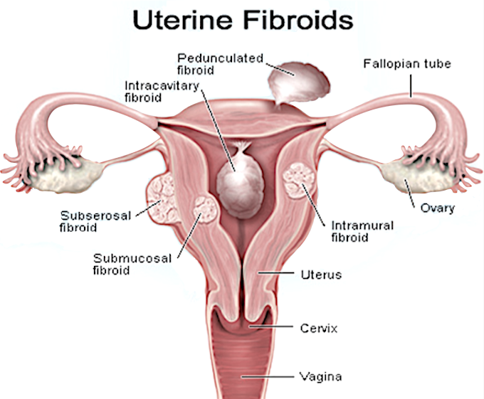 Uterine fibroid symptoms and Causes