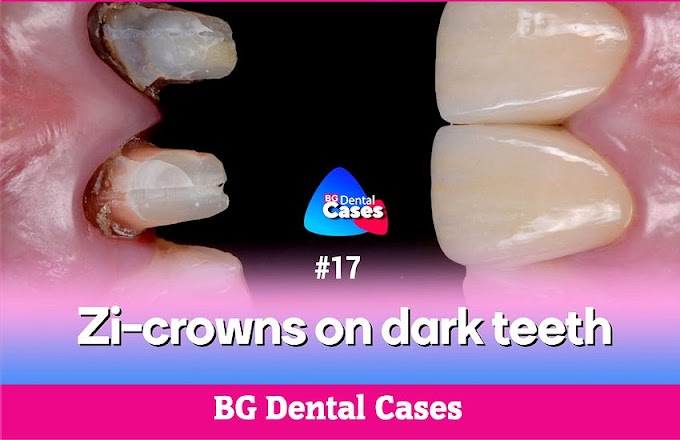 MONOLITHIC ZIRCONIA CROWNS: Zi-crowns on dark teeth - BG Dental Cases