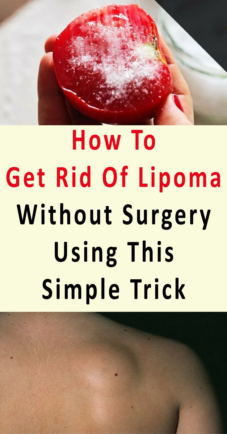Health Care Using This Simple Remedy , How To Get Rid Of Lipoma Without