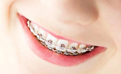Niềng răng bị móm có hiệu quả không?