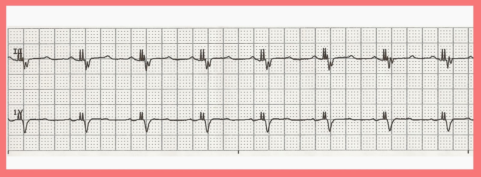 EKG Rhythm Strip Quiz 200