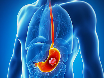 http://gastrosurgeoncochin.com/stomach-cancer.html