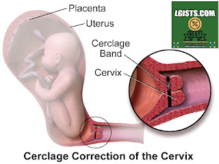 Cervical incompetence Cervical incompetence