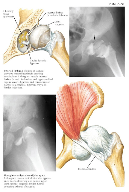 ADAPTIVE CHANGES IN DISLOCATED HIP THAT INTERFERE WITH REDUCTION