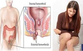 Obat Herbal Penyembuh Wasir