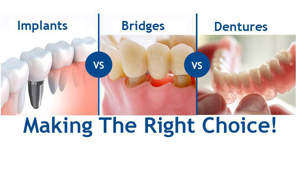 What Are The Alternatives To Dental Bridges? ~ Dr. Bharat Katarmal Dental &  Implant Clinic