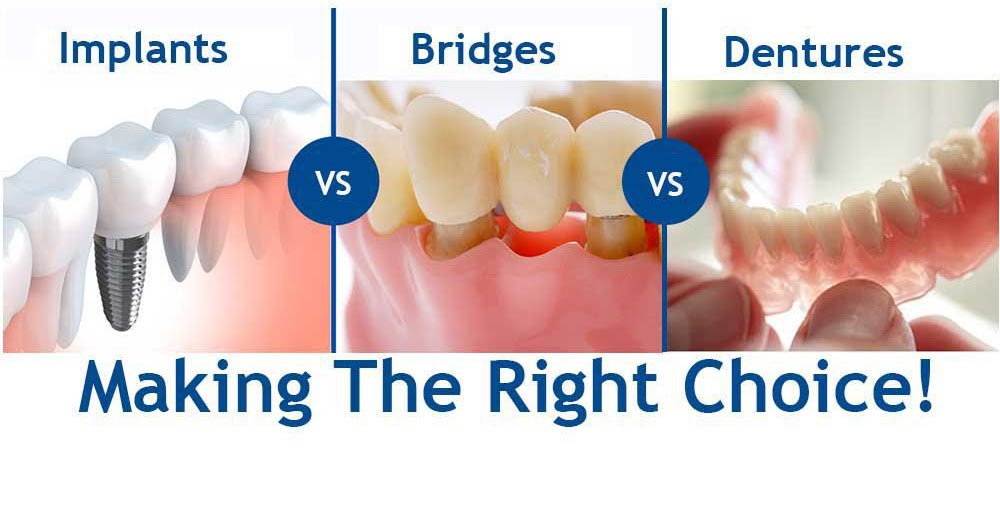 What Are The Alternatives To Dental Bridges? Dr. Bharat Katarmal