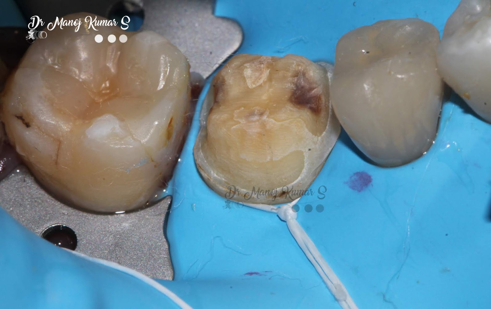 Case 45 Cementation protocol for an emax lithium disilicate crown