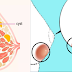 These 5 Super Foods Can Remove Breast Cyst and Stop its Growth Naturally
