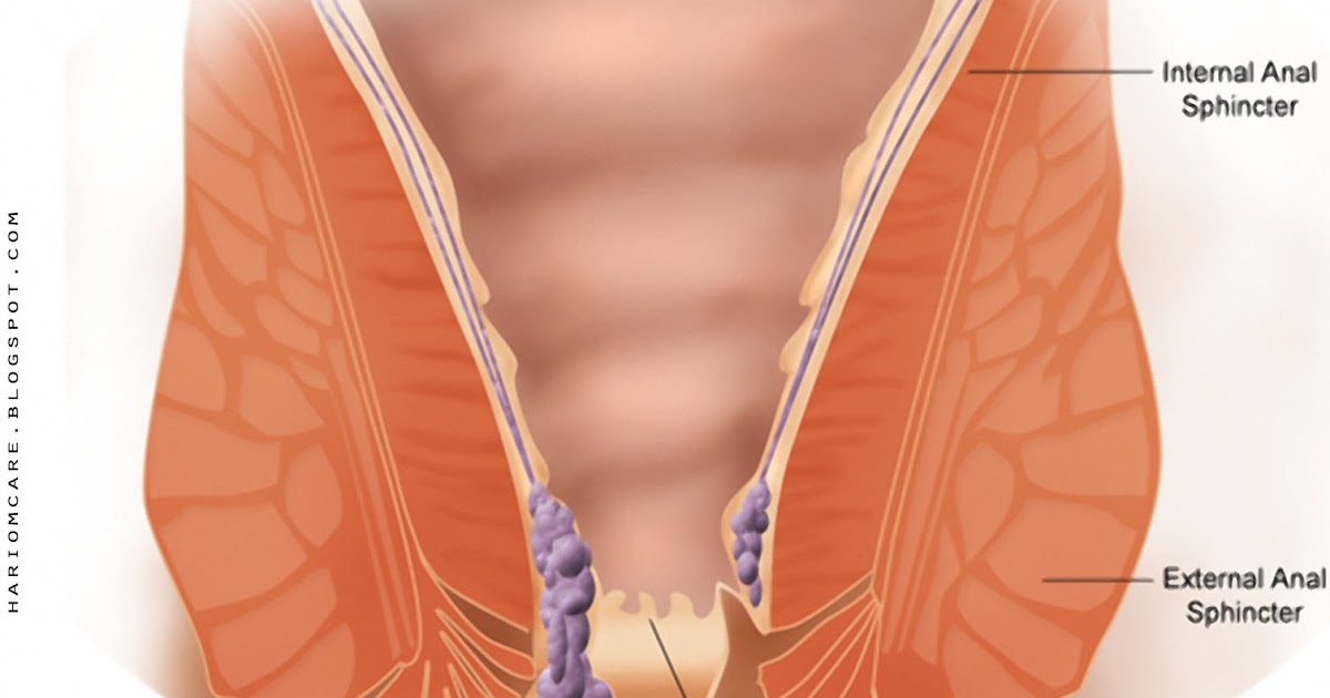 Тромбированный внешний узел геморрой. Тромбоз геморроидального узла. Геморрой внутри прямой кишки. Геморроидальная шишка наружная. Появились боли в заднем проходе