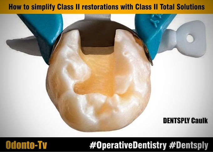 POSTERIOR RESTORATIVE: How to simplify Class II restorations with Class II Total Solutions