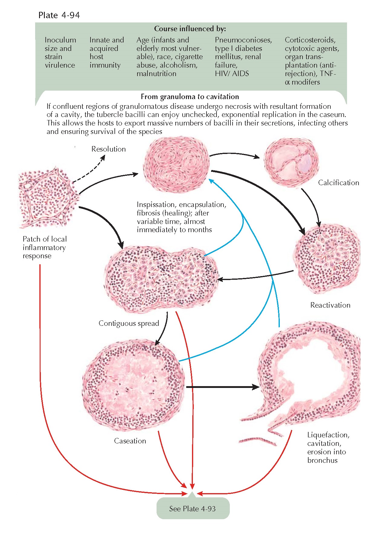 TUBERCULOSIS pediagenosis