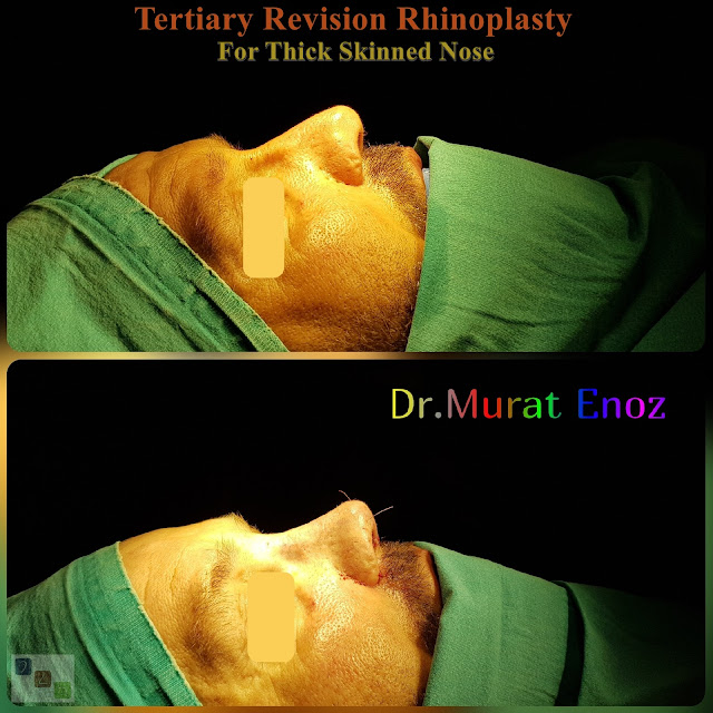revision rhinoplasty, tertriary rhinoplasty for men istanbul, 3rd nose job, 3rd nose aesthetic surgery, micromotor assisted revision rhinoplasty, micro-motor assisted revision nose asthetic surgery
