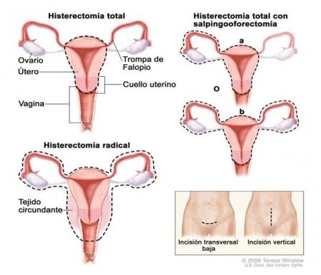 Relaciones sexuales despues de histerectomia