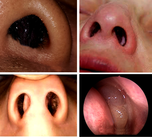 Nasal polyps Signs and symptoms, Causes, Types, Diagnosis, and Treatment.