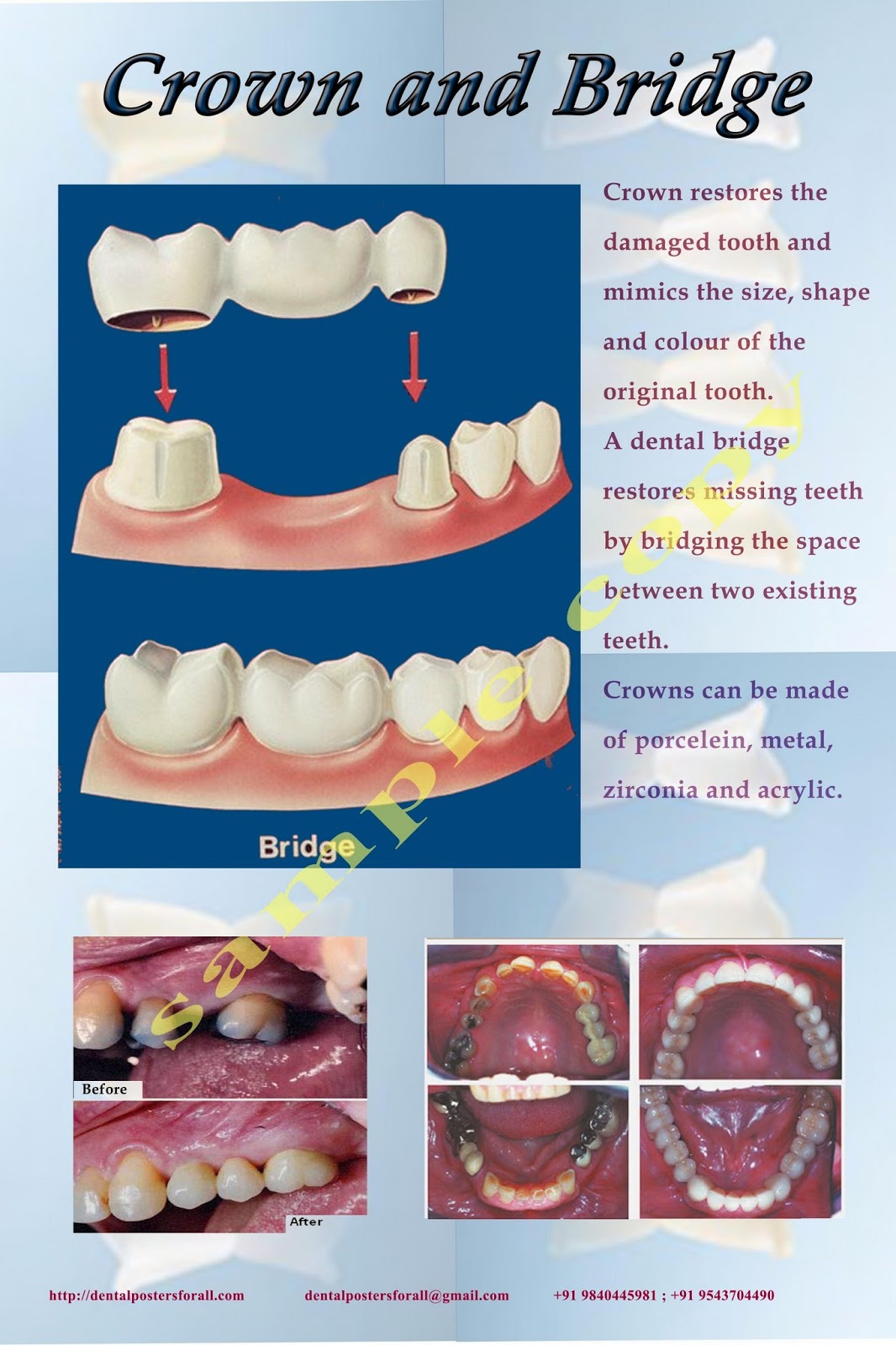 Dental Posters to Educate Patients Crown and Bridge