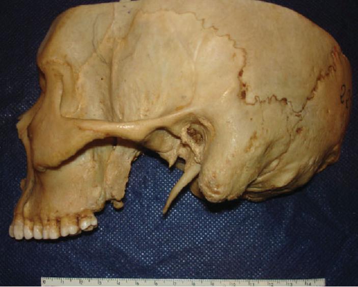 Dentistry lectures for MFDS/MJDF/NBDE/ORE: Eagle's Syndrome.....A note