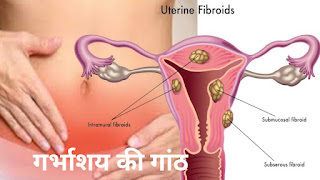 Uterine Fibroid in Hindi.