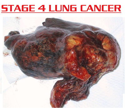 stage 4 lung cancer | stage 3 stage 2 stage 1 image