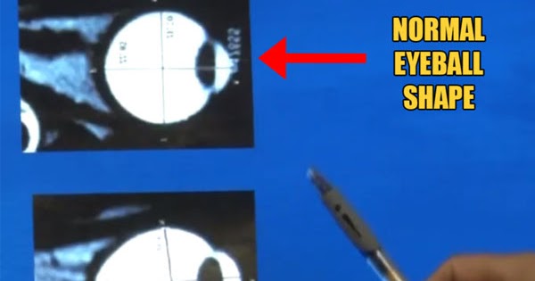 Tahap Power Rabun Jauh : OPTIK SOFYAN: CARA MENCEGAH DAN MENGATASI