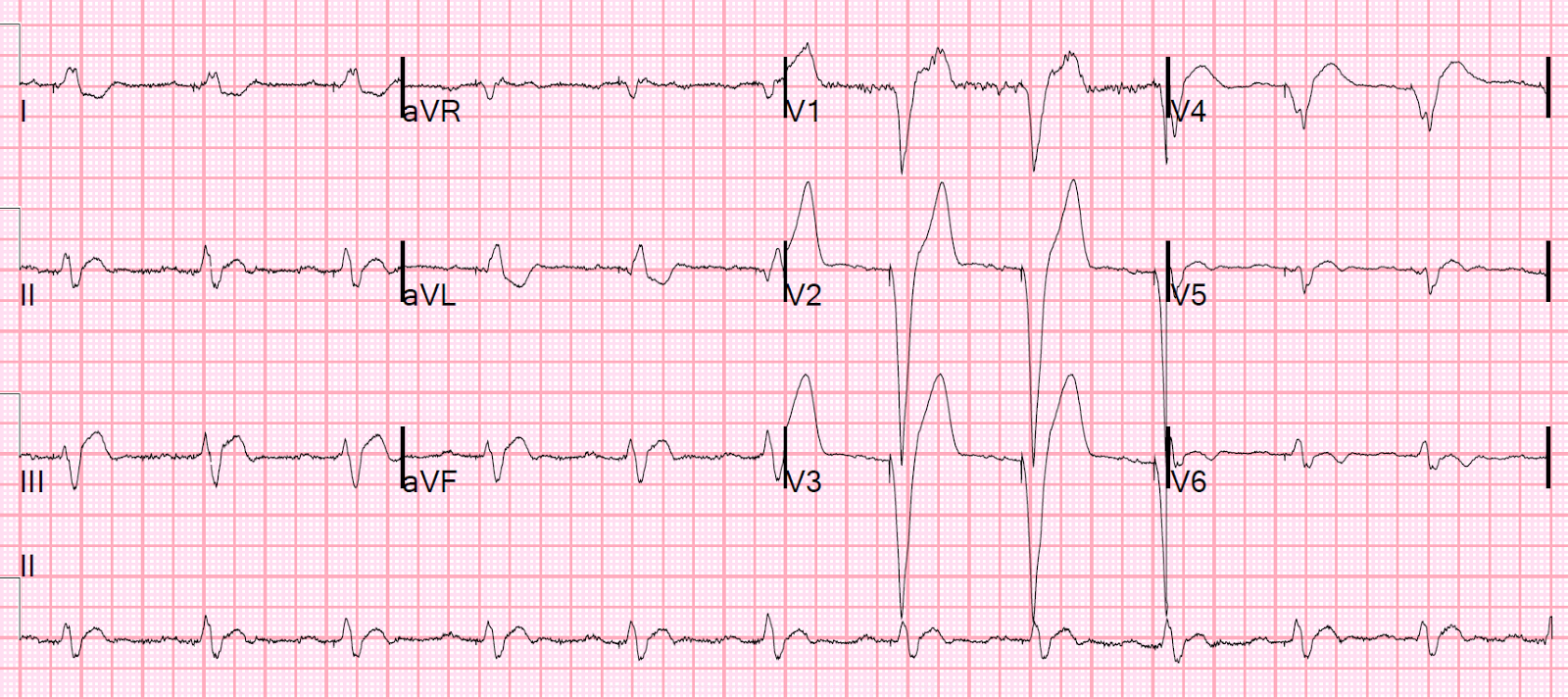 ventricular paced rhythm with failure to capture ventricular paced rhythm with failure to capture